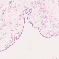 漿液性嚢胞腺腫